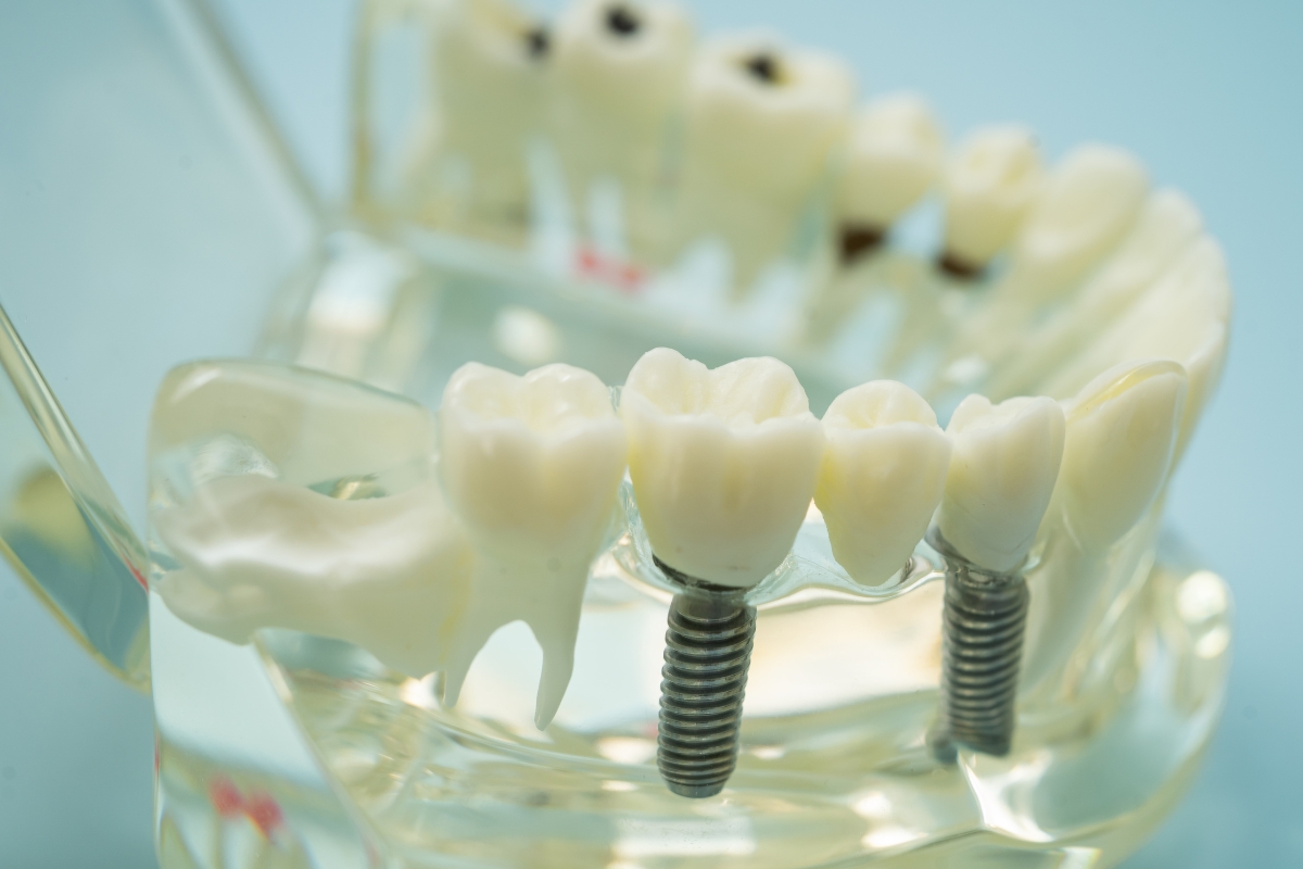 dental-implants-in-Florence