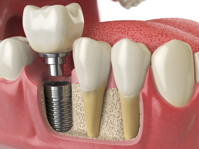 Healing After Dental Implants: Recovery Timeline for Patients