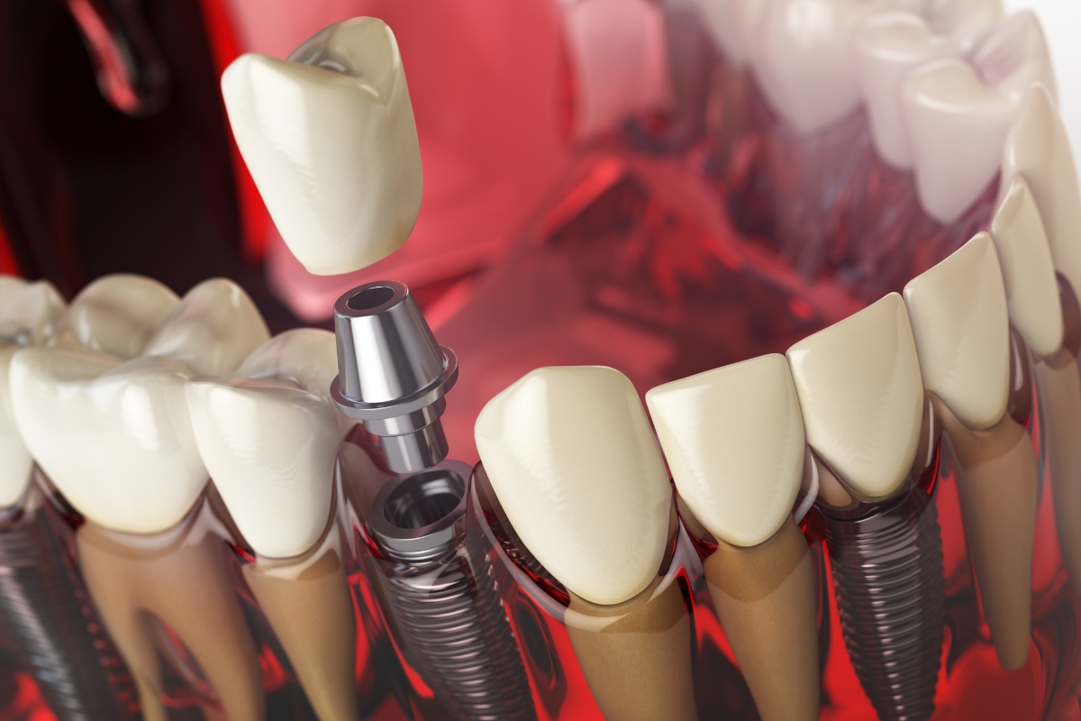 Dental Implants Florence